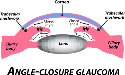 An illustration of angle-closure glaucoma